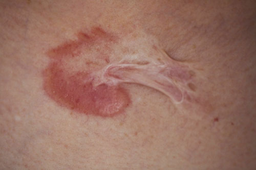 scar, personal injury claim